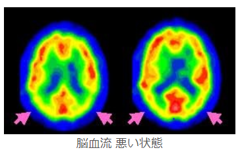 脳 悪い状態